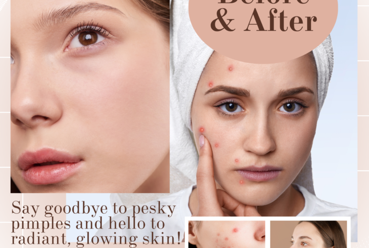 Unveiling Clear Skin with Orgo Best: A Journey to Acne-Free Confidence